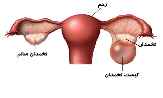 هورمون های زنانه و سندرم تخمدان پر کیست